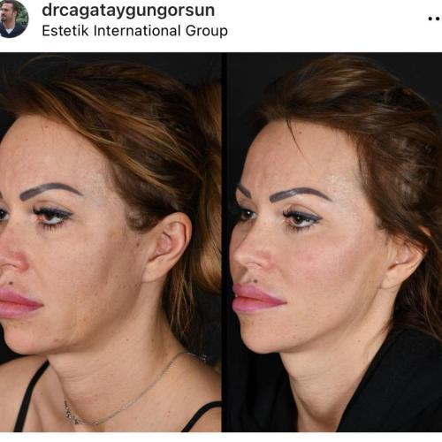 подтяжка лица паутиной Фотографии до и после